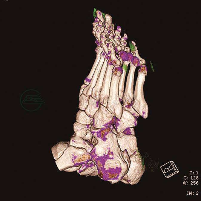 图1 患者双能CT提示痛风石沉积，绿色示痛风石沉积